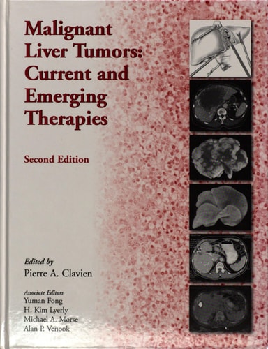 Malignant Liver Tumors Current and Emerging Therapies