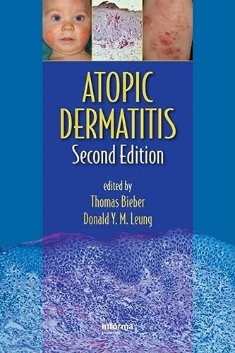 Atopic Dermatitis, Second Edition