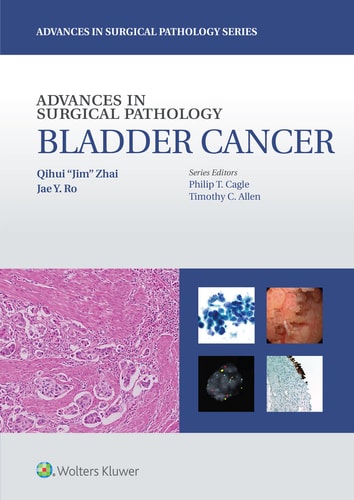 Advances in Surgical Pathology Bladder cancer