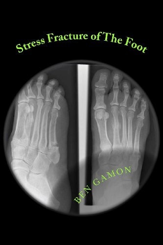 Stress Fracture of the Foot