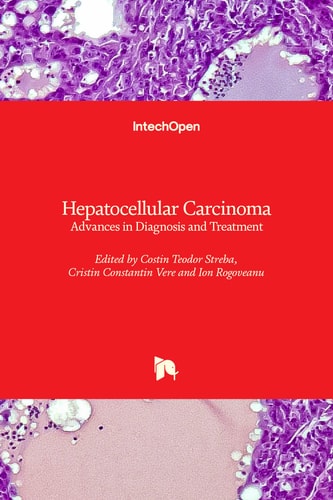 Hepatocellular Carcinoma Advances in Diagnosis and Treatment