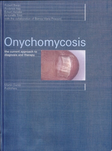 Onychomycosis The Current Approach to Diagnosis and Therapy