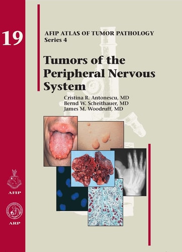 Tumors of the Peripheral Nervous System