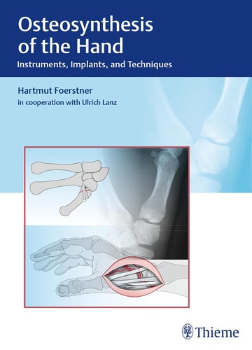 Osteosynthesis of the Hand Instruments, Implants, and Techniques