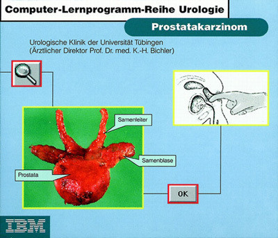 Prostatakarzinom