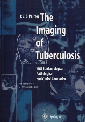 The Imaging of Tuberculosis With Epidemiological, Pathological, and Clinical Correlation