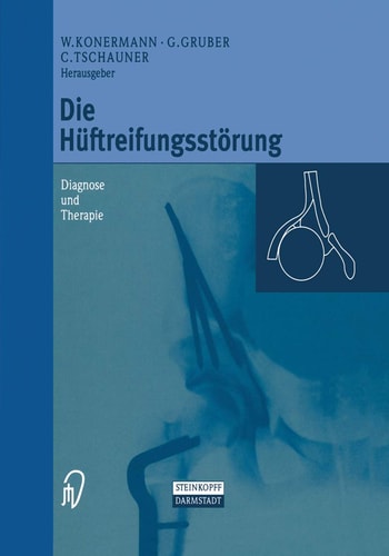 Die Hüftreifungsstörung Diagnose und Therapie