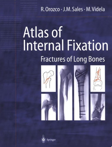 Atlas of Internal Fixation