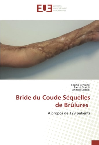 Bride du Coude Séquelles de Brûlures: A propos de 129 patients (French Edition)