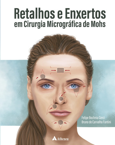 Retalhos e Enxertos em Cirurgia Micrográfica de Mohs