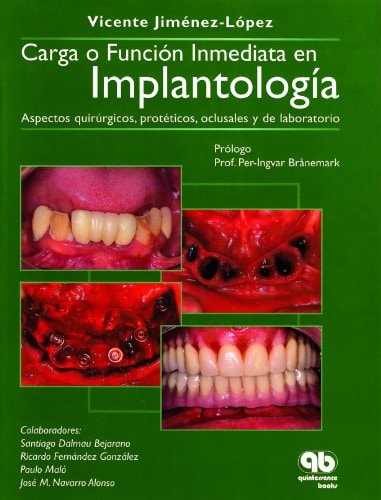 Carga o función inmediata en implantología Aspectos quirúrgicos, protéticos, oclusales y de laboratorio