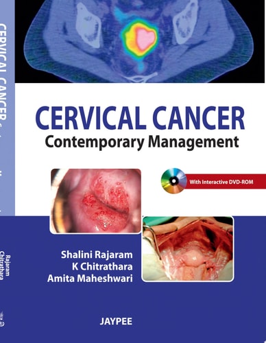 Cervical Cancer Contemporary Management