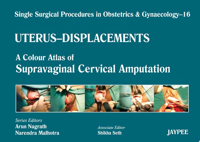 Single Surgical Procedures in Obstetrics and Gynaecology–16: A Colour Atlas of Supravaginal Cervical Amputation (Nadkarni's) A Colour Atlas of Supravaginal Cervical Amputation