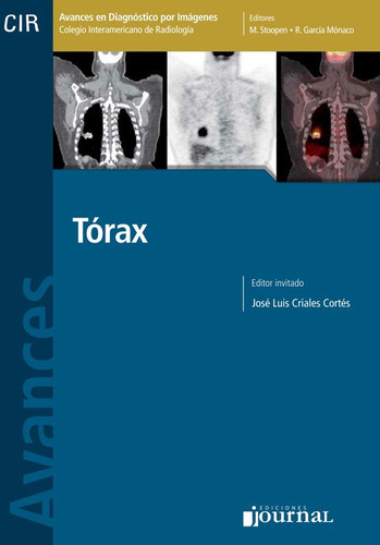 Avances en diagnóstico por imágenes: Torax
