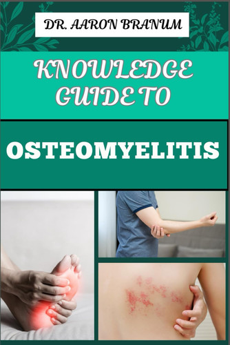 Knowledge Guide to Osteomyelitis Essential Manual To Diagnosis, Treatment, Prevention, and Advanced Therapies for Bone Infection Management