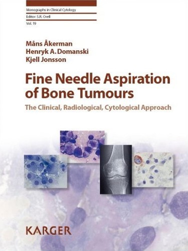 Fine Needle Aspiration of Bone Tumours