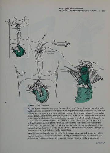 Digestive Tract Surgery