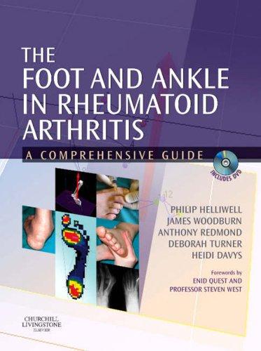 The foot and ankle in rheumatoid arthritis