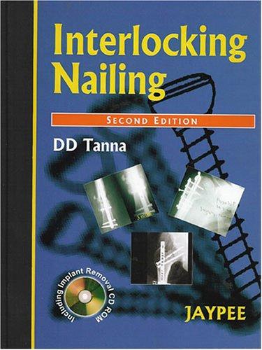Interlocking Nailing