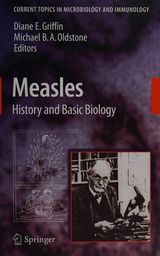 Measles