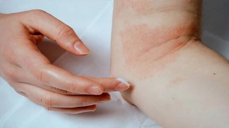 طبيبة جلد تكشف عن أنواعا نادرة من الحساسية هي أشد خطورة