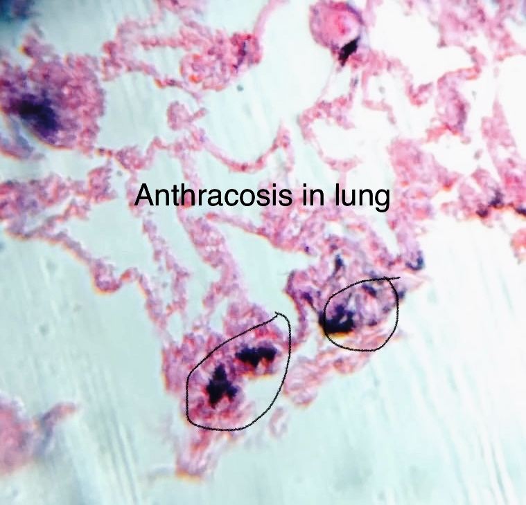 Anthracosis-2.jpg