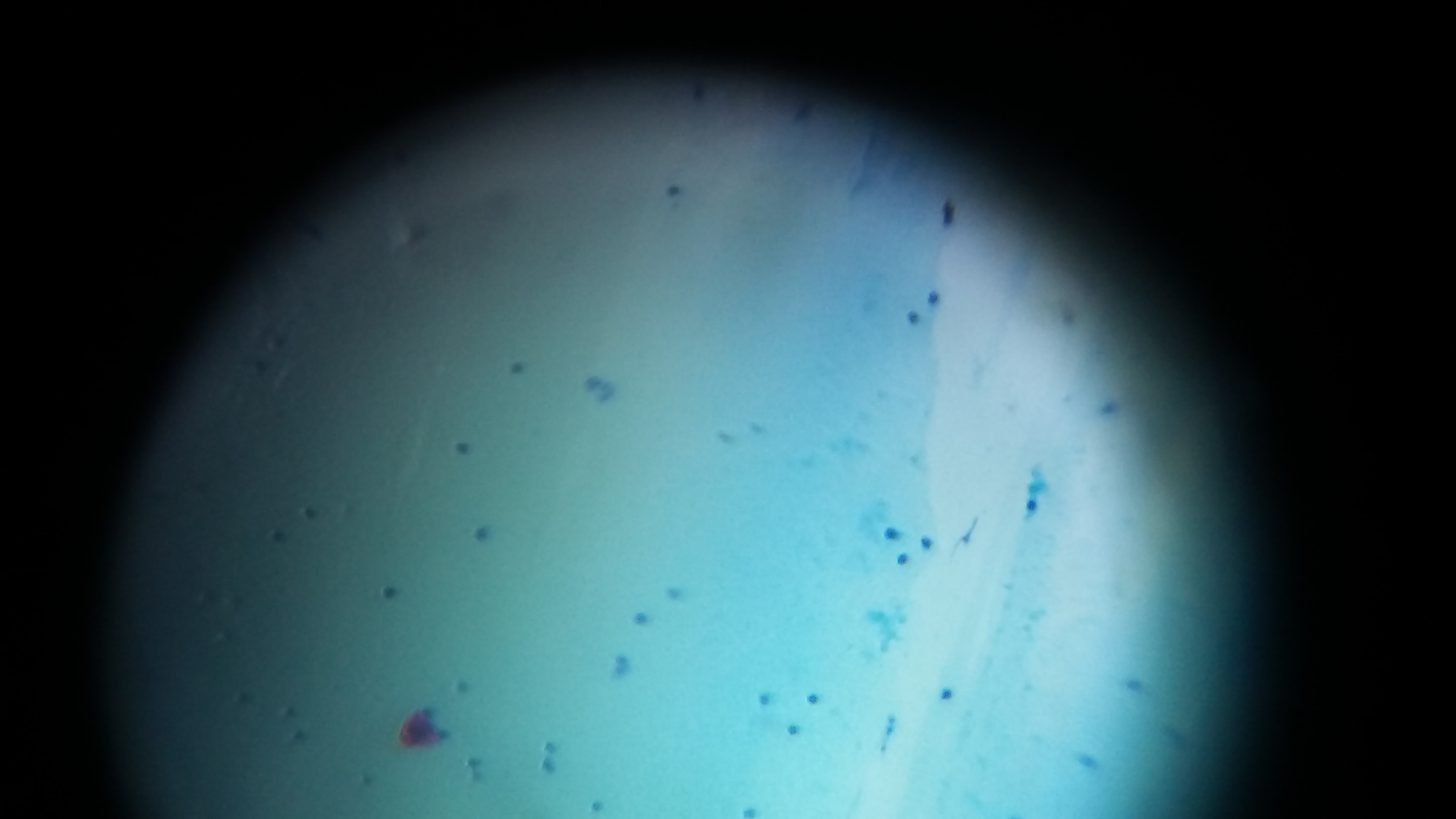 AFB-SMEAR-PLEURAL-FLUID.jpg