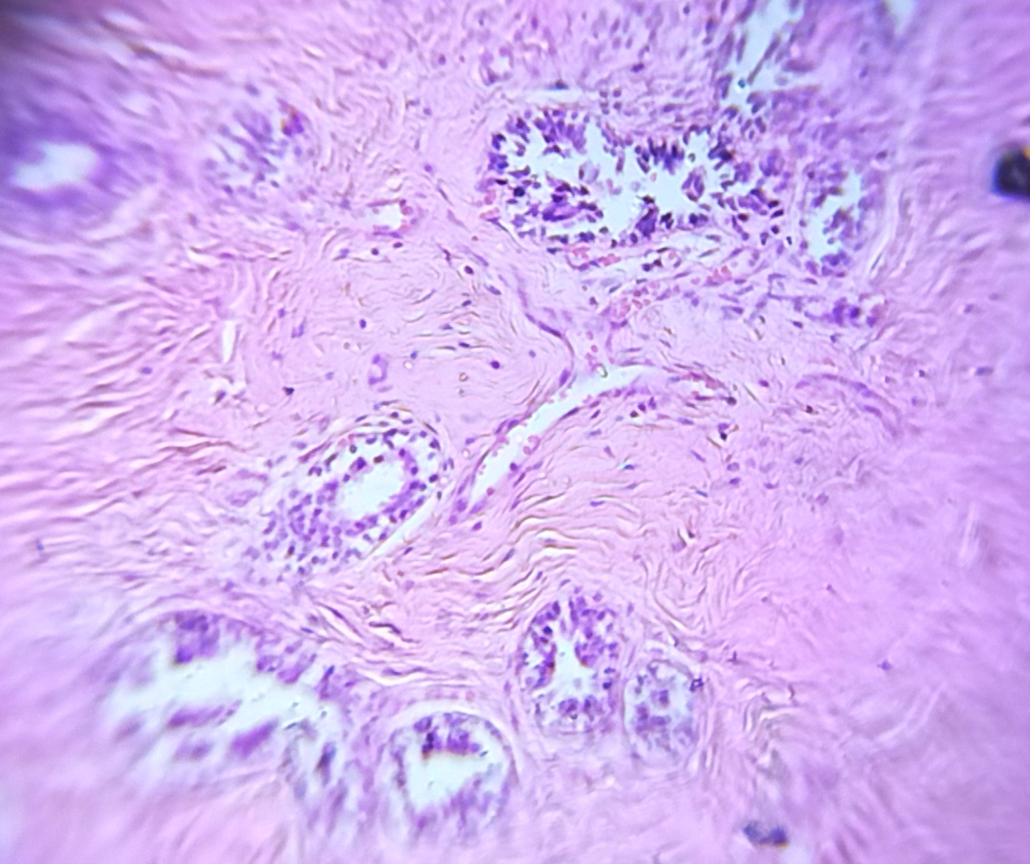 breast-cancer-tissue-3.jpg