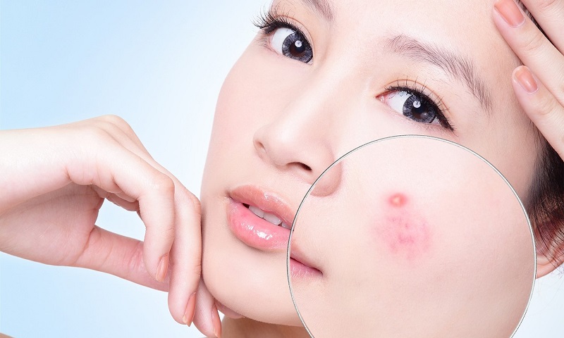 kem trắng da trị mụn