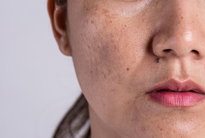trị nám da sau sinh