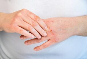 Remedy for itching irritation in hands