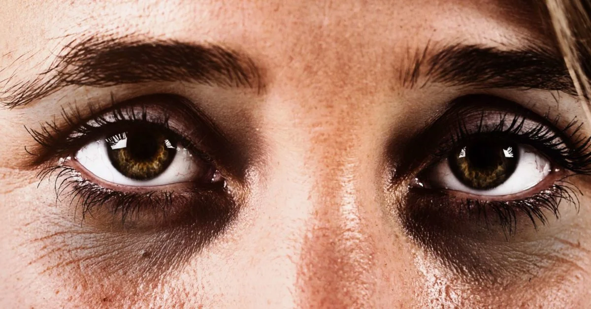 Dark circles under the eyes