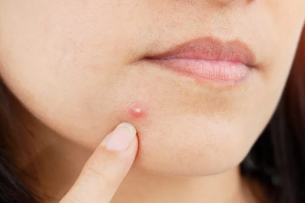 How to Prevent from Pimples Minnambalam Health Care News