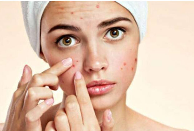Are there any permanent solutions to get rid of pimples?