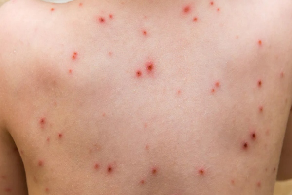 spread of viral diseases in tamilnadu