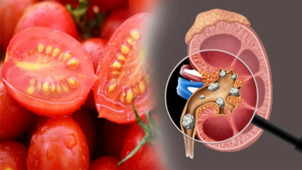 Tomatoes Cause Kidney Stones?