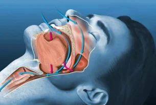 How to Stop Snoring easily