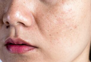 Skin discoloration causes and treatment