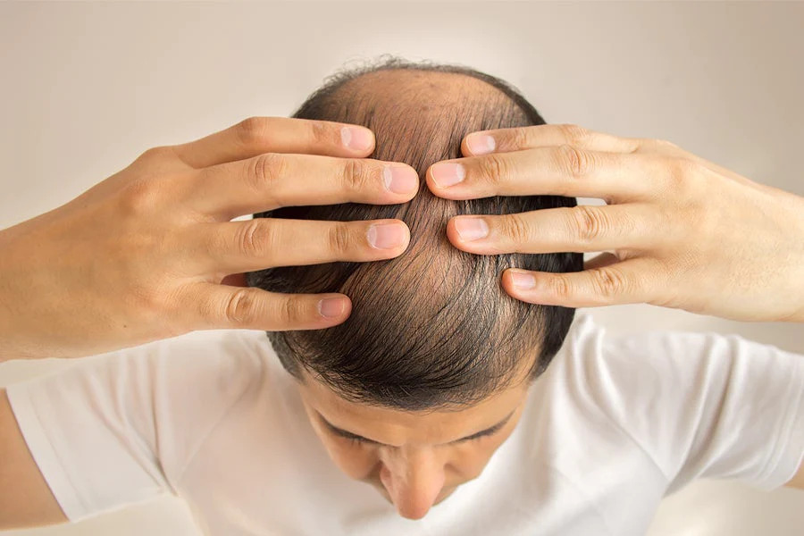 Weight loss and hair loss