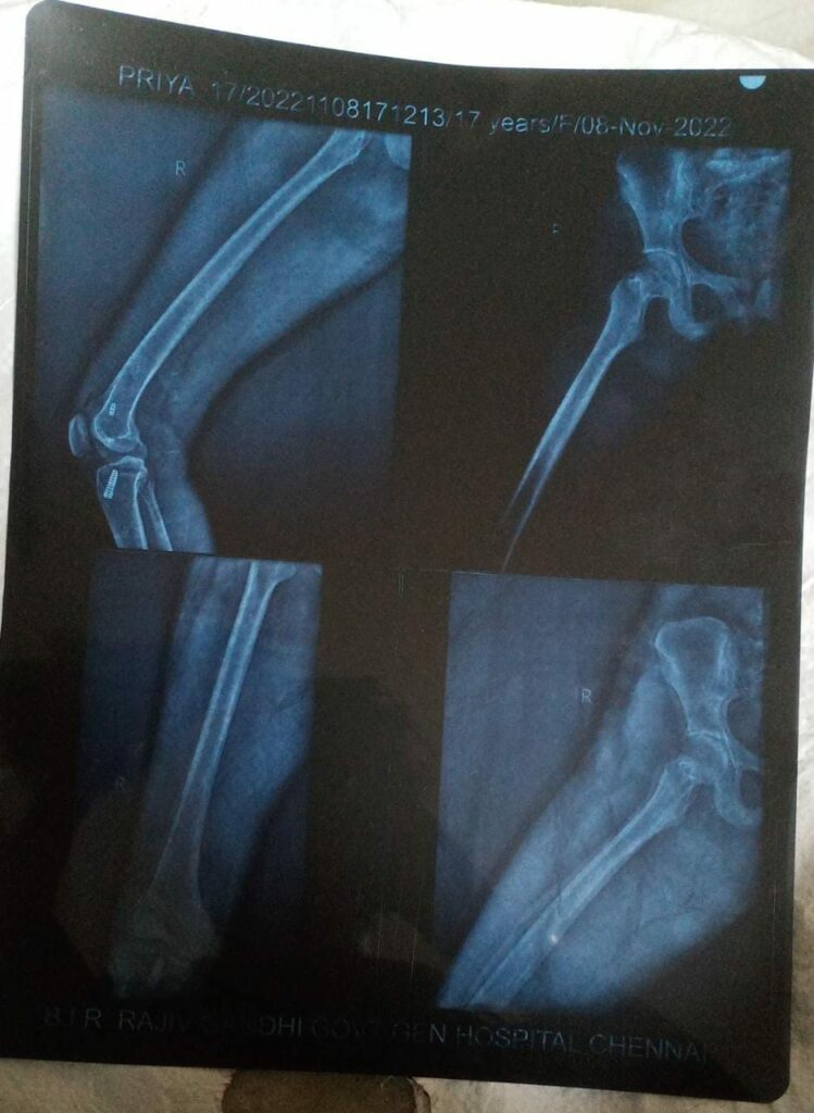 what happened to football player priya in periyar nagar hospital