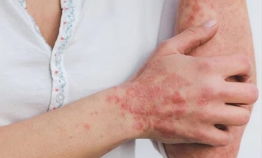 Tips to Prevent Psoriasis in Summer