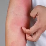 Treatment for sudden body swelling