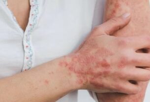 Tips to Prevent Psoriasis in Summer