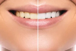 How to remove yellow stains from teeth?
