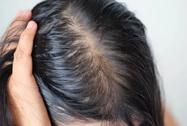 how to stop hair loss