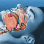 How to Stop Snoring easily