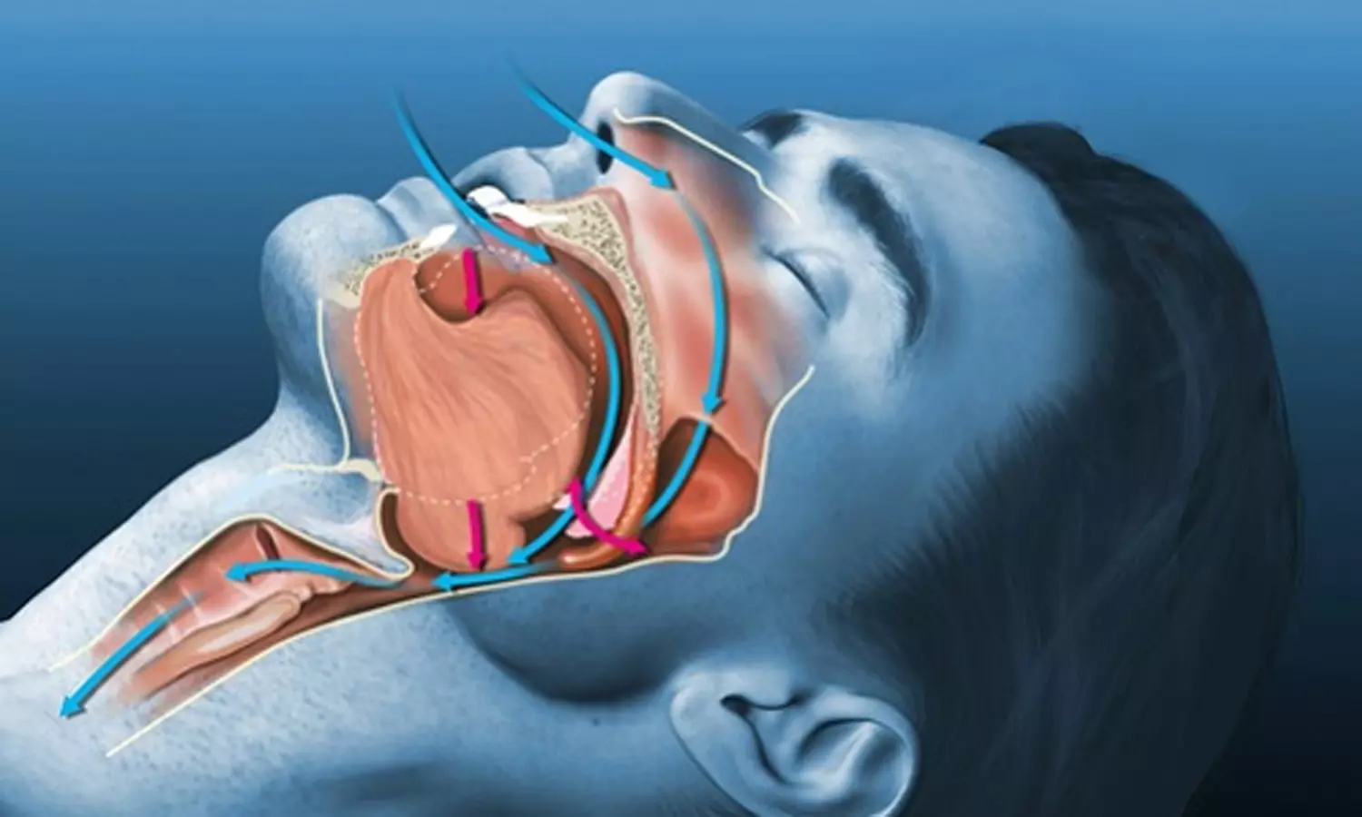 How to Stop Snoring easily