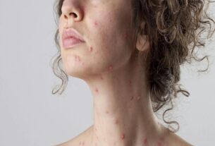 Can Remove Chickenpox Scars from Face