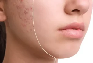 Tips to Avoid Pimples and Acne