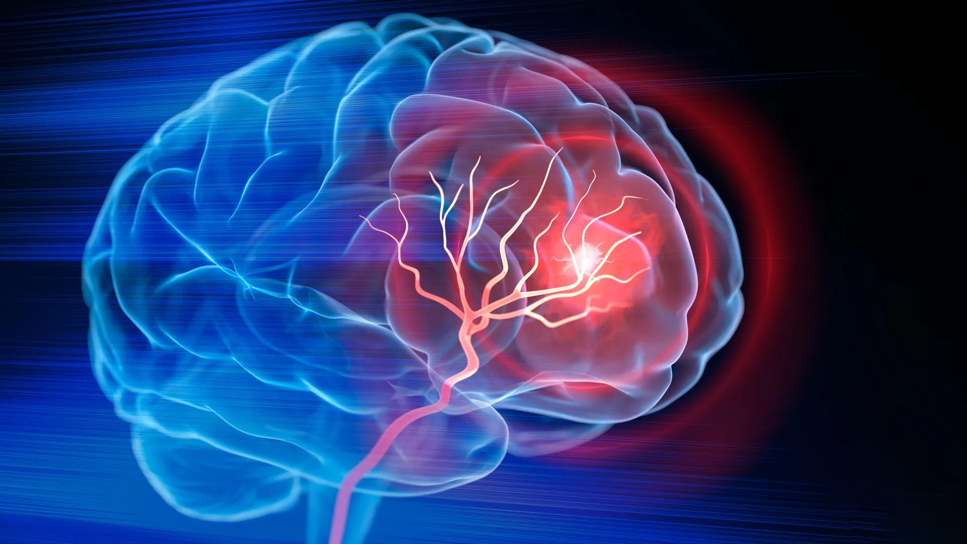 Stroke Rates Nearly Double Among Adults Aged 20 to 54 Over Three Decades, Study Finds